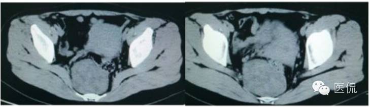 病例丨病理结果「医看2016苏州阅片大赛」病例资料11：血管肌纤维母细胞瘤#医学影像#