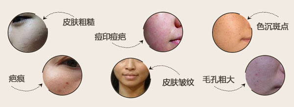 痘坑点阵激光治疗,激光去祛痘坑安全吗