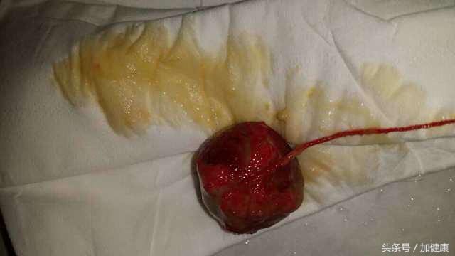 加健康资讯：假如“小妹妹”得了炎症该怎么科学处理