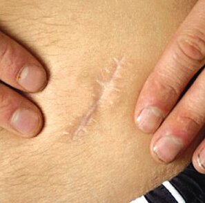 手术缝针疤痕怎么去除,嘴角缝针疤痕去除最佳时间