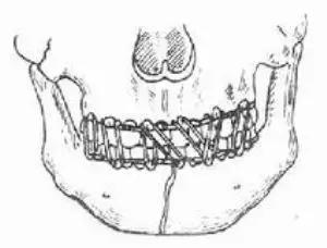 外伤致面部骨折怎么恢复,面部骨折注意事项大全