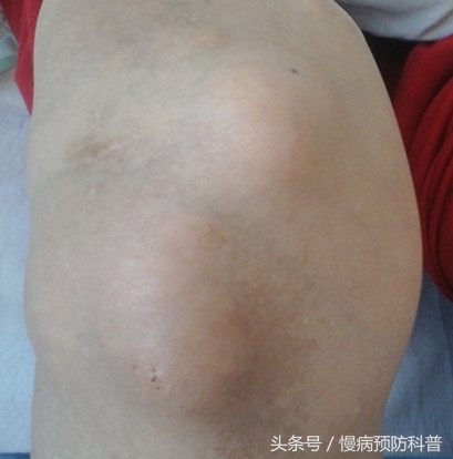 痛风反复发作教你一招让痛风缓解,医生痛风发作