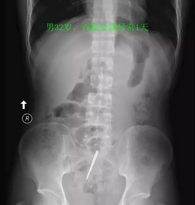 X光片里的体内异物，简直大开眼界