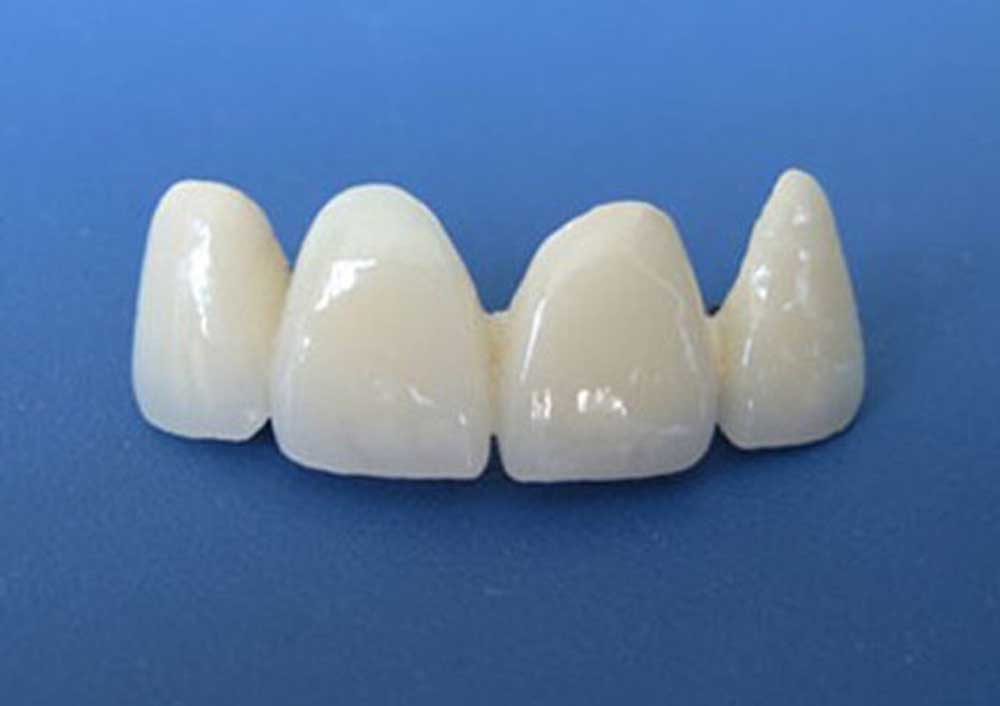 烤瓷牙怎么防止变色,烤瓷牙会变形吗