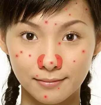 各个地方长痘的原因以及解决方法,长痘到底是什么病啊