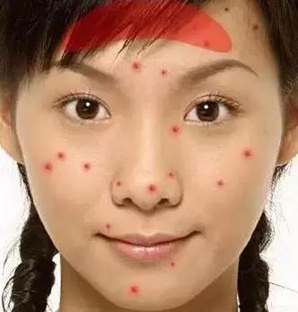 突然长很多痘是有什么病吗,3种长痘的原因了解一下你中了吗