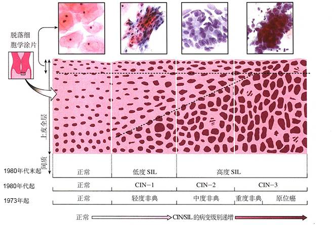 宫颈癌：你不知道的和该知道的
