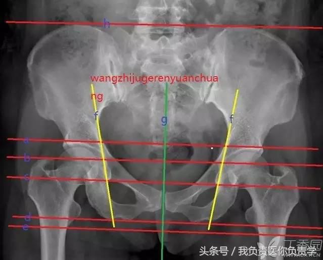 正常骨盆x线片详解,骨科医生只看报告单