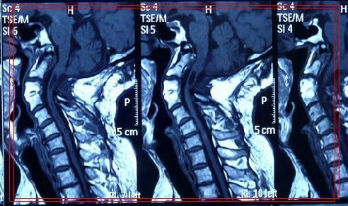 小脑扁桃体下疝畸形患者,小脑扁桃体下疝畸形的临床表现