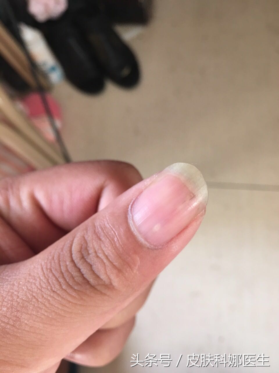 指甲里扎了个刺没重视一年后会痛,指甲里像扎了竹签一样痛什么原因