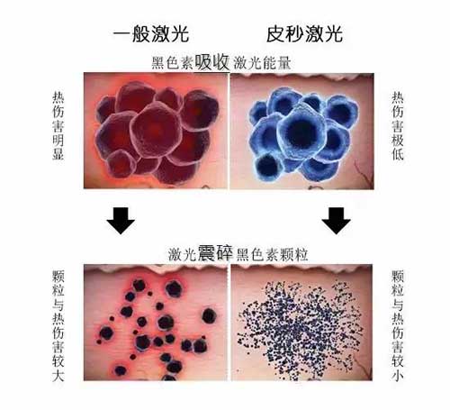 超皮秒激光祛斑2022价目表,激光皮秒祛斑一到七天变化图