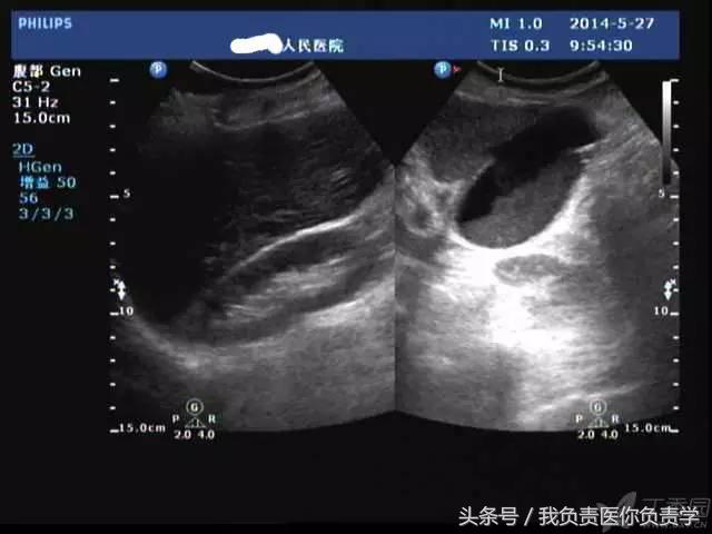 楂樻墜杩涢樁鑵拌吂璁粌,鑳嗗泭缁撶煶绌垮瓟鐥囩姸