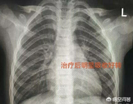 孩子得了肺炎一定要输液吗？医生：请避开这9个认知误区