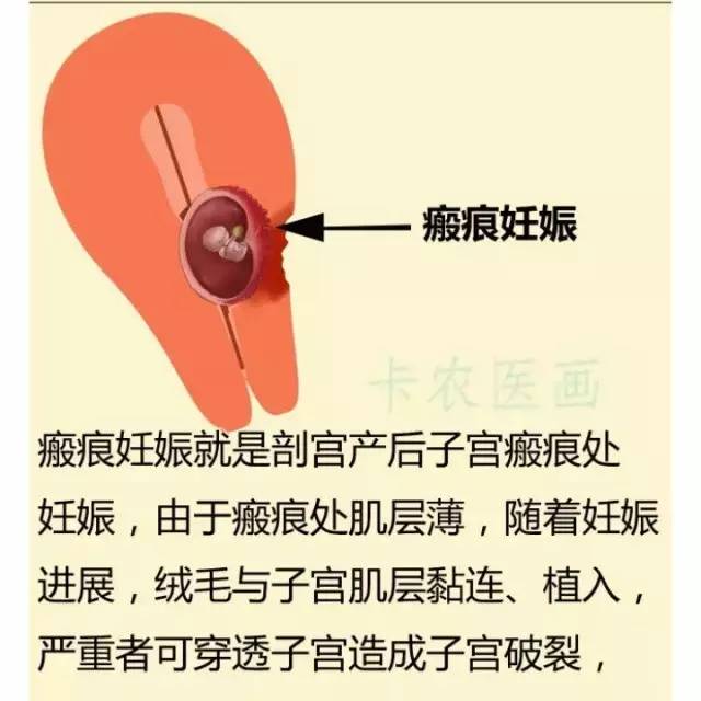 输卵管结扎术会有什么后遗症,输卵管结扎术对女性的伤害大吗