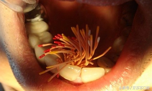 杀神经后牙齿还疼,杀牙神经的牙齿遇热会疼