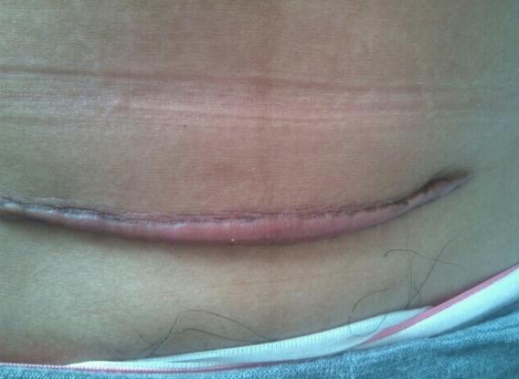 剖腹产要经过几道工序,剖腹产只需切一层