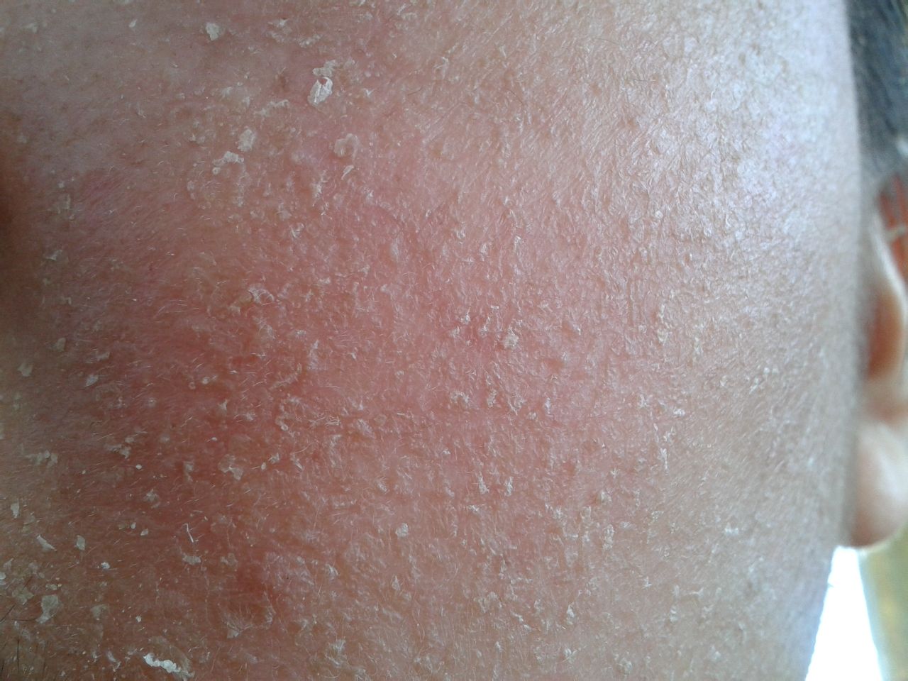 激素皮炎可以吃中药治疗吗,激素皮炎喝中药能彻底治愈吗