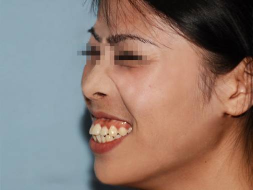 牙齿不齐可以戴隐形牙套吗,牙齿不齐一定要戴钢牙吗