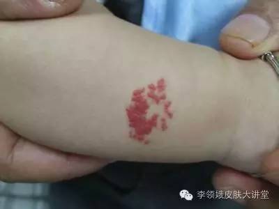 婴幼儿血管瘤边界欠清,婴幼儿血管瘤会破皮吗