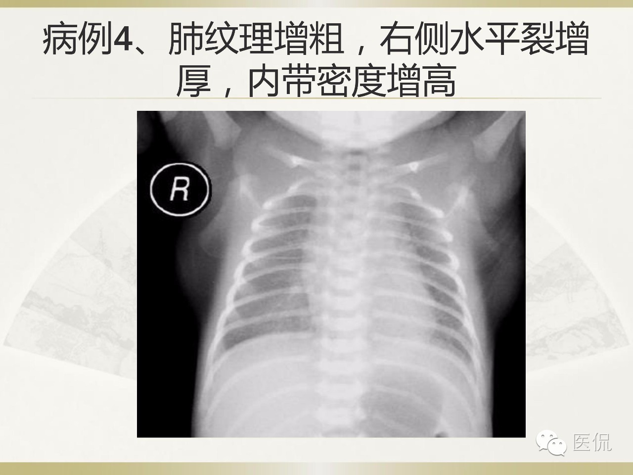 「资料丨医看分享」南边老师肺部群：新生儿透明膜病（HMD）医学影像