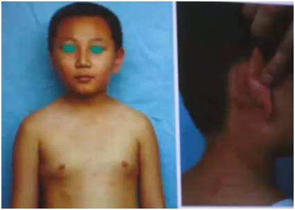 诊断麻疹最快速的方法,麻疹怎么做检测