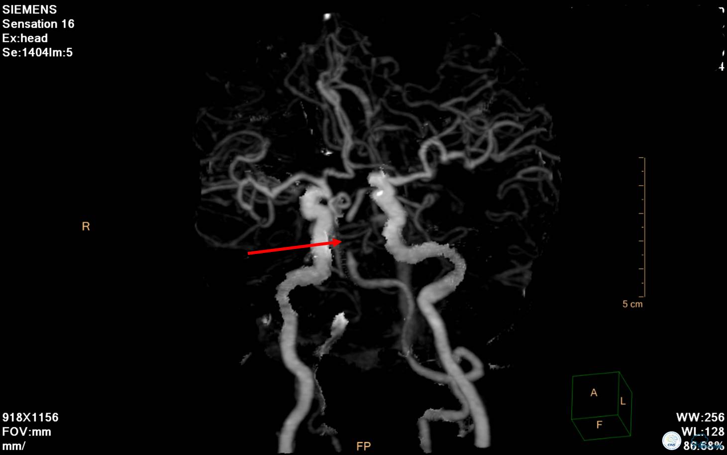 中医治疗基底动脉闭塞,基底动脉尖综合征病例分享