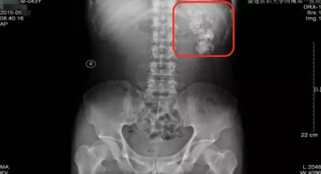 肾结石治疗最佳方案钬激光碎石,治疗肾结石案例