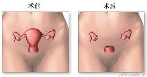 妇科最常见的肿瘤，到底应该怎么办