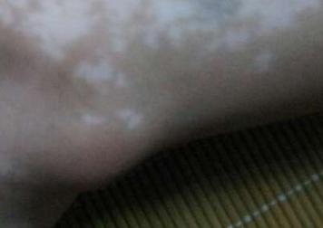 白癜风会遗传下一代吗怎样预防,白癜风好了以后怎么预防复发