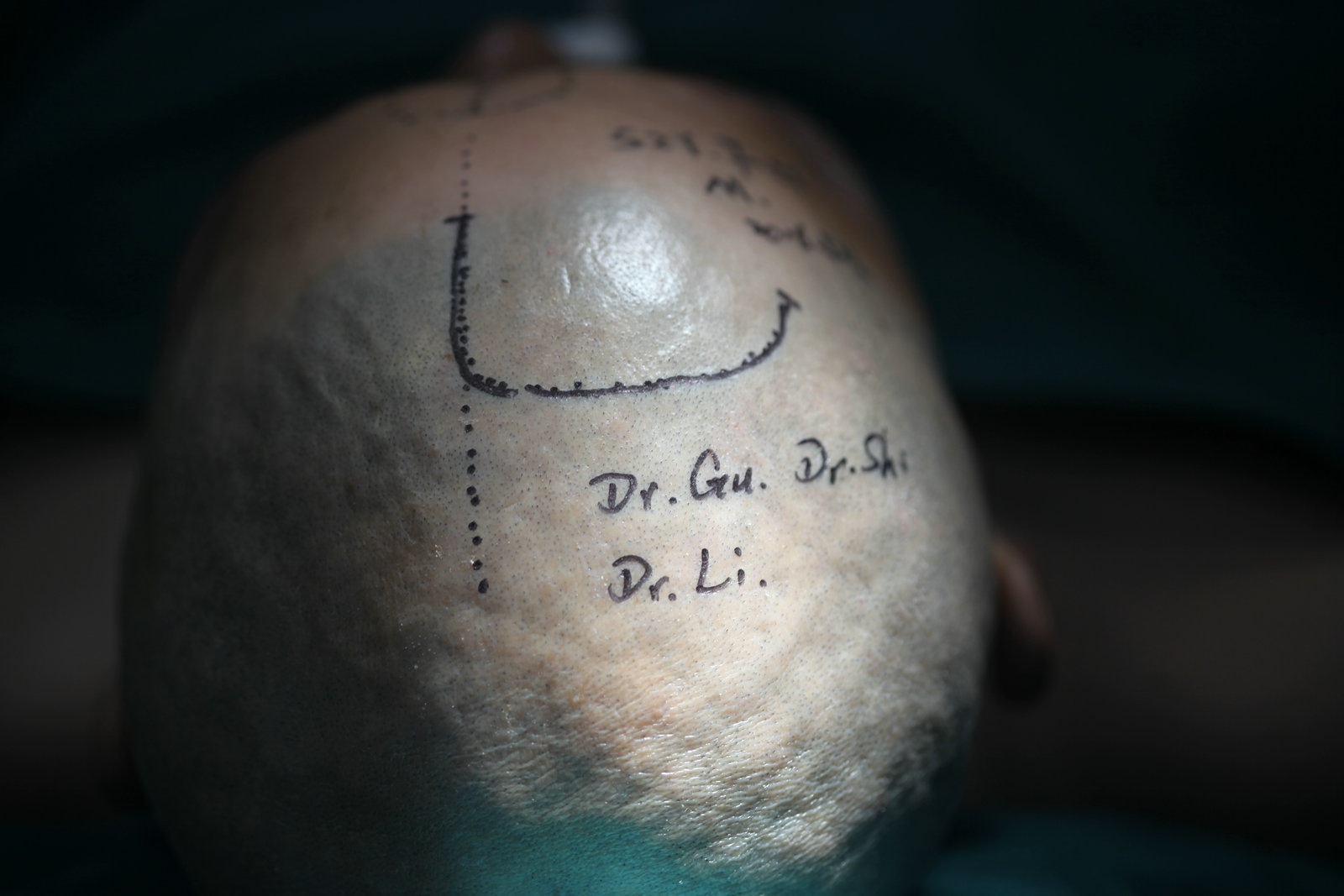 神经外科纪实视频,显微神经外科手术费用