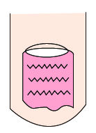 大拇指指甲出现纵纹凸出是什么病,指甲出现黑色的纵纹