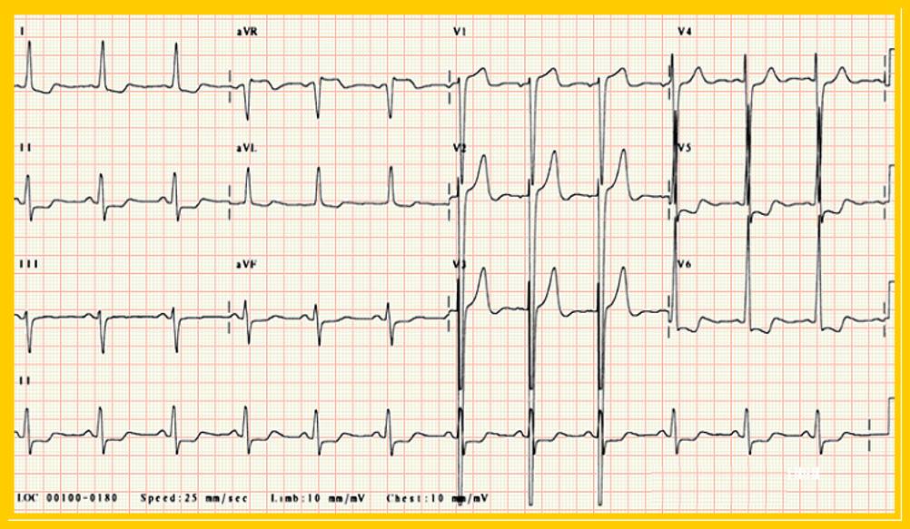 心电图st段呈j点型抬高是什么意思,心电图st段抬高一定是心梗吗