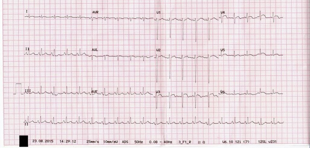 心电图st段呈j点型抬高是什么意思,心电图st段抬高一定是心梗吗