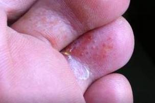 香港脚用什么快速治好,香港脚的最佳治疗方法泡脚