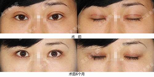 双眼皮手术眼角不对称,左右双眼皮不对称怎么改善