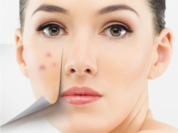 右脸长痘痘是什么原因_怎样快速消除痘痘