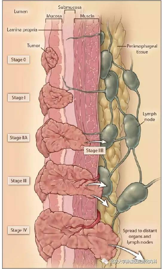 直肠癌最新辅助治疗结果,直肠癌治疗研究进展