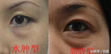 去黑眼圈浮肿的眼霜,去眼袋神奇的眼霜