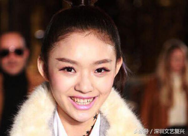 林允整牙效果怎么样,林允整牙后变化图片