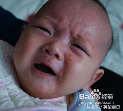 宝宝湿疹妈妈的心酸,宝妈战胜湿疹的经验