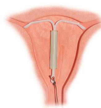 节育环伤害了妈妈二十多年,被节育环害惨的女人