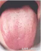 中医舌诊图谱100例,靠谱中医史上最全高清舌诊图谱