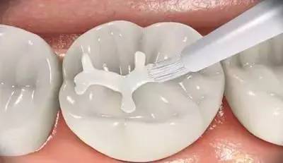 乳牙蛀了需要去拔吗,乳牙蛀了需要治疗吗