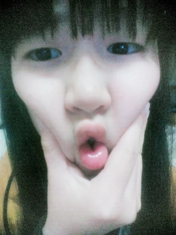 抽脂双眼皮做完眼睛有褶,割双眼皮肿成一条缝