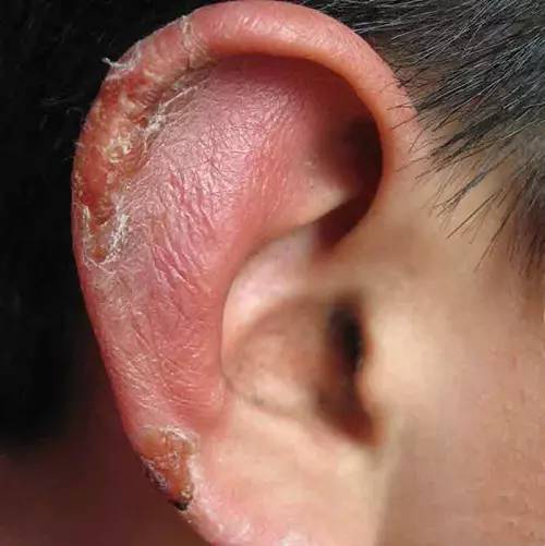 冬天生冻疮怎么办简单方法,冬天长冻疮是因为太冷了吗