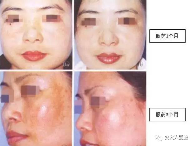 抗糖美白丸好还是美白饮好,美白丸真有美白的效果么