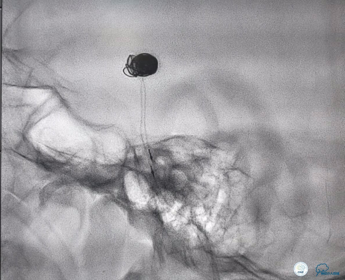 颈动脉瘤介入栓塞康复后可活多久,动脉瘤微创栓塞术全过程