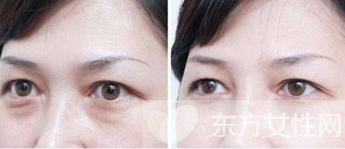 眼部的脂肪粒怎么去除小窍门,眼部长脂肪粒怎样才能除去脂肪粒