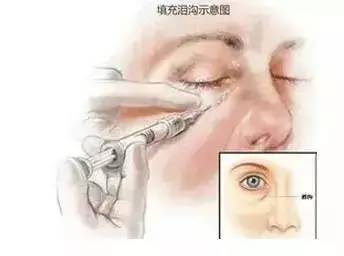 有泪沟怎么办最有效方法,有泪沟怎么办