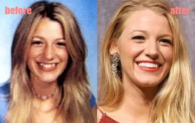 整牙=整容？看杨幂、刘涛、高圆圆为你亲身示范！